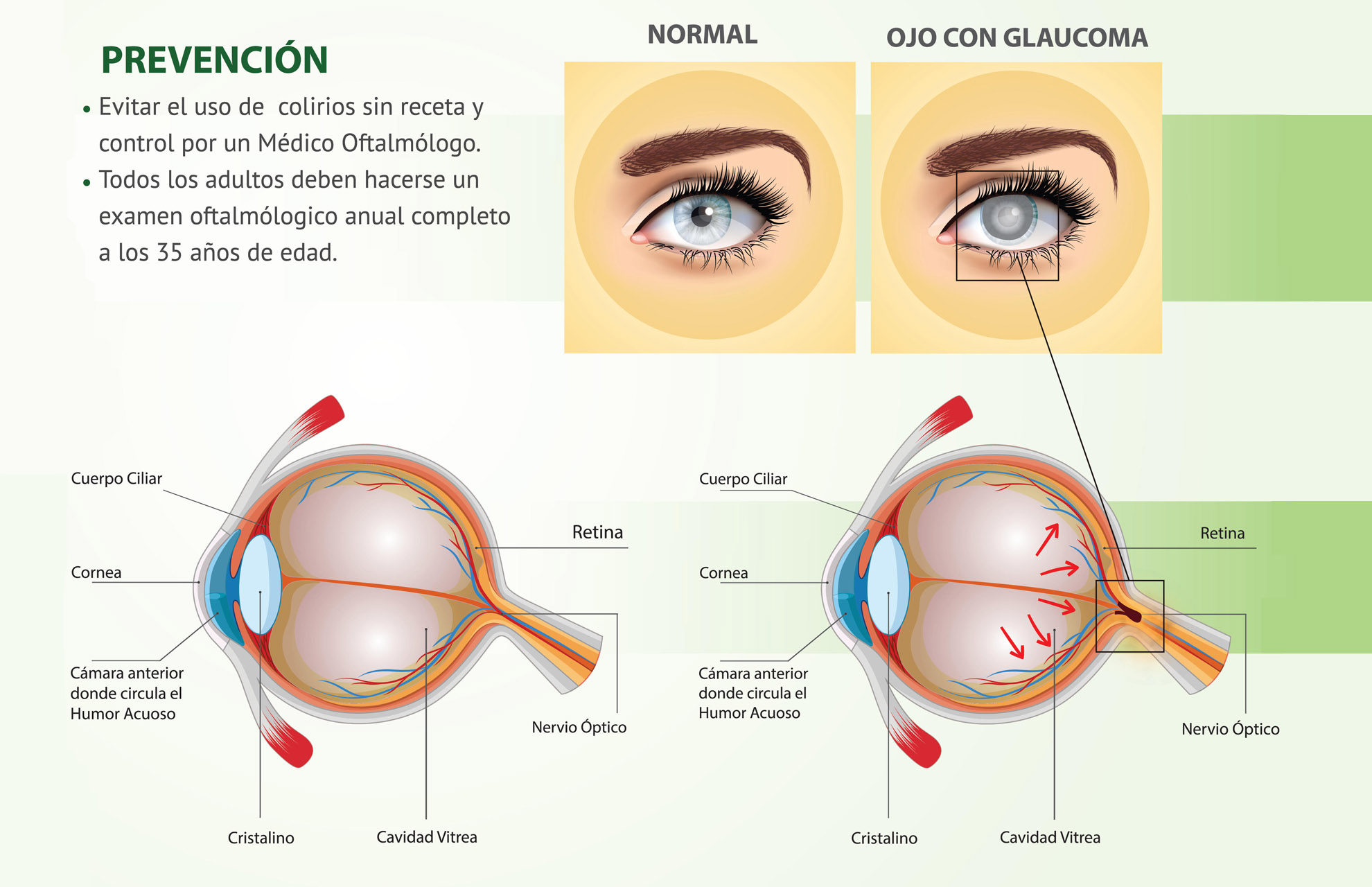 Glaucoma ¡conózcalo Y Prevéngalo 0099