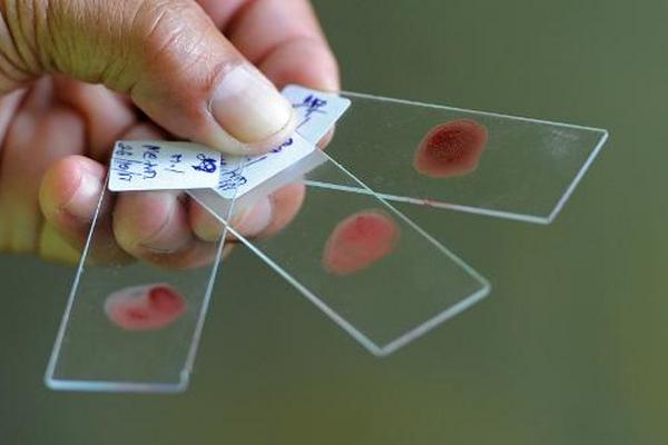 Un examen de sangre experimental ha demostrado ser prometedor para la detección de cáncer de pulmón. (FOTO: Prensa Libre: AFP)