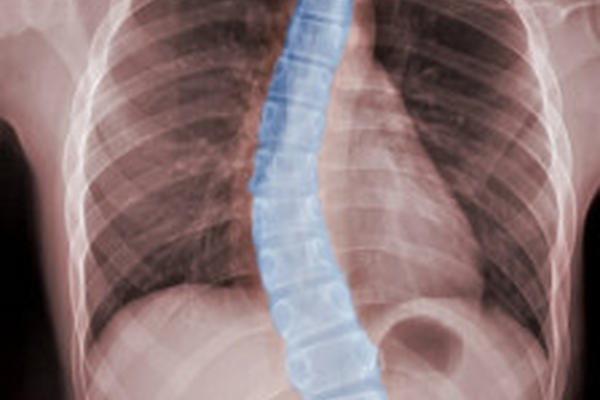 Tratamiento de imanes para tratar escoliosis