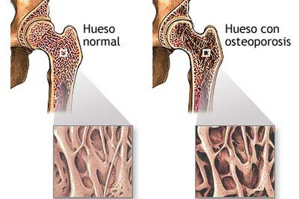 un-test-sangu-neo-identifica-riesgo-de-osteoporosis-prensa-libre