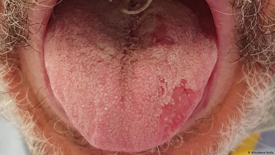 COVID tongue and different signs of the coronavirus on the pores and ...