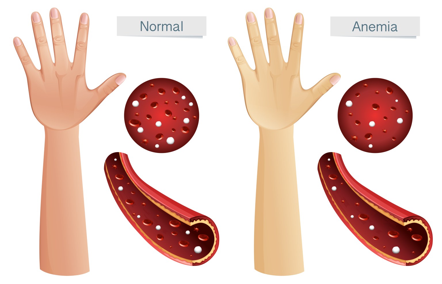 anemia-mind-map