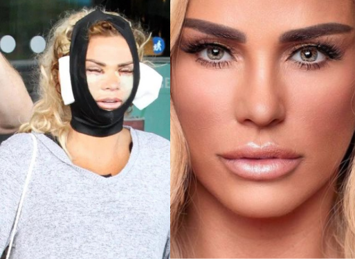 El drama de Katie Price, la exmodelo que se sometió a cinco cirugías  estéticas (por qué pensó que moriría)