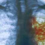 Radiografía de una persona con tuberculosis. (Foto Prensa Libre: Hemeroteca PL)