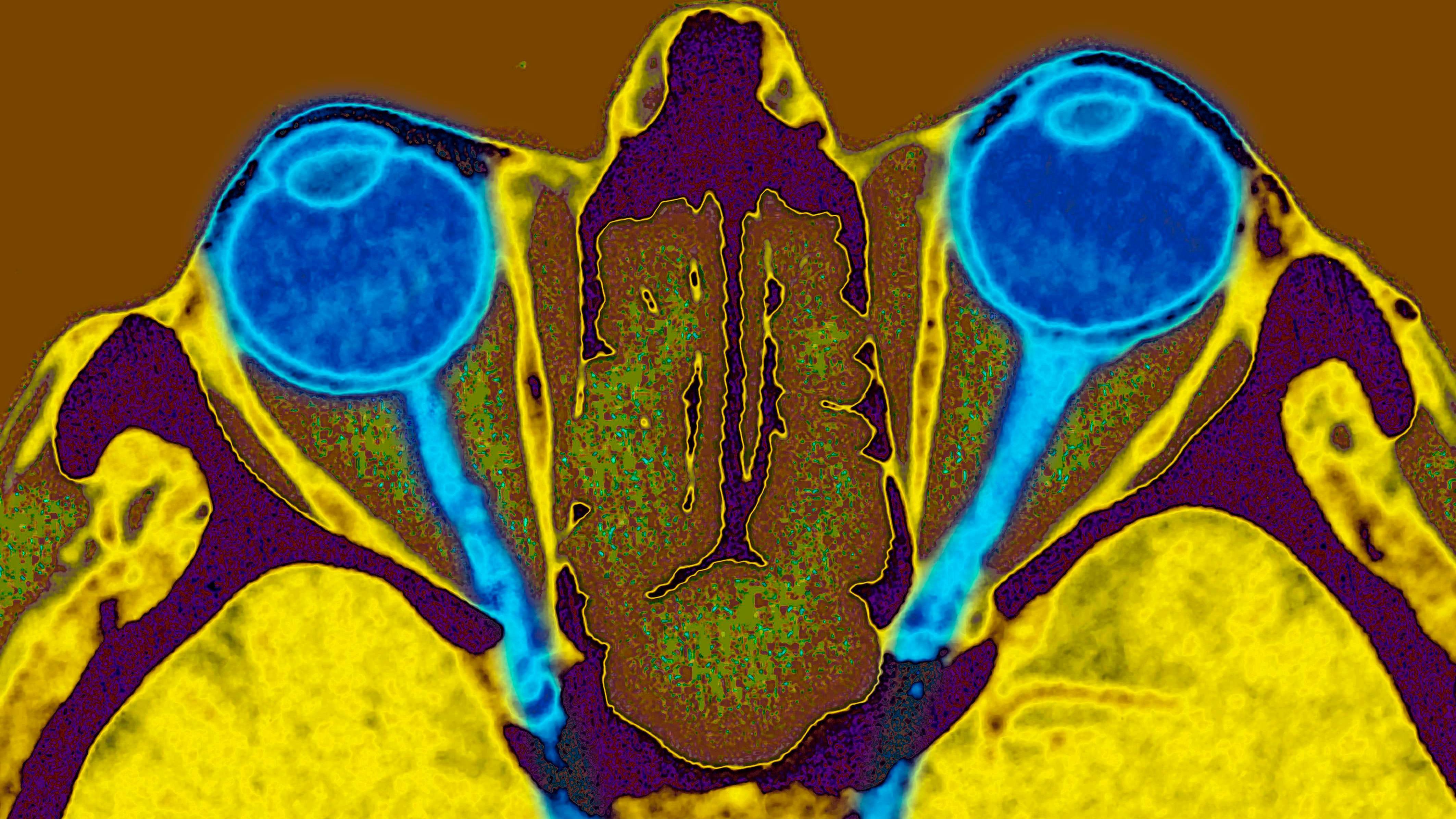 Dos ojos conectados a sus nervios ópticos (foto BSIP/Universal Images Group)