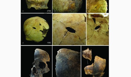 Fragmentos de cráneo, con indicios de traumatismo por objeto contundente y cortes, hallados en la fosa común de Charterhouse Warren, en el suroeste de Inglaterra. (Foto Prensa Libre: Schulting et al. 2024, Antiquity vía The New York Times)