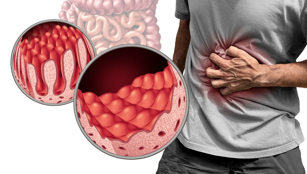 Celiac disease or coeliac disease as an intestinal anatomy medical concept with normal villi and painful small intestine lining as an autoimmune disorder with 3D illustration elements.